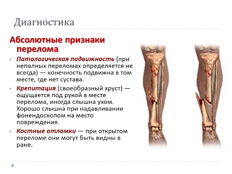 Диагностика Абсолютные признаки перелома Патологическая подвижность (при неполных переломах определяется не всегда) — конечность